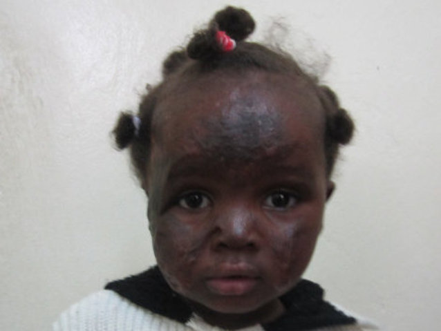 Shameem from Kenya raised $1,500 to repair a facial scar from a burn ...