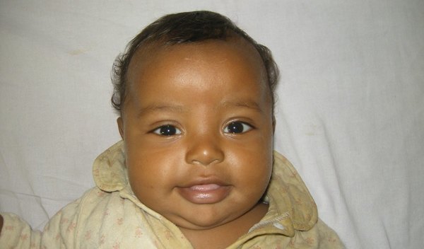 Photo of Tariku post-operation