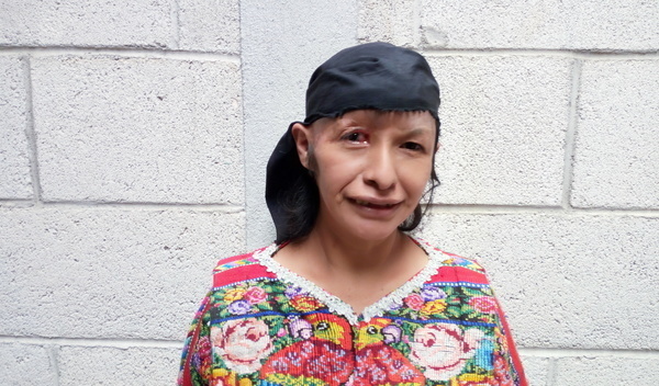 Photo of Juana post-operation