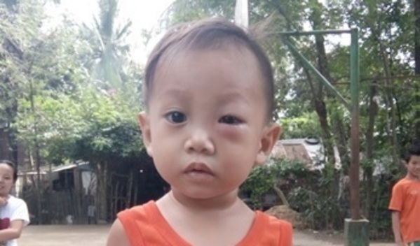 Photo of Adrian post-operation