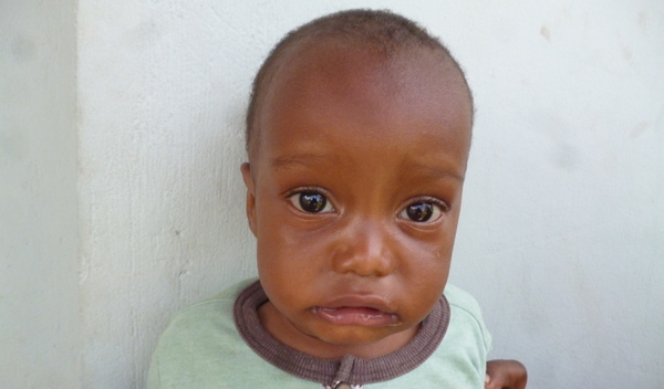 Photo of Obadia post-operation