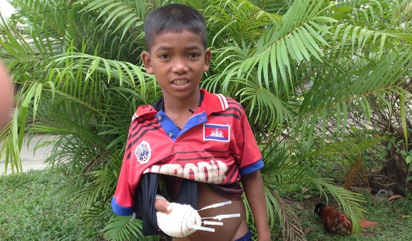 Photo of Chandy post-operation