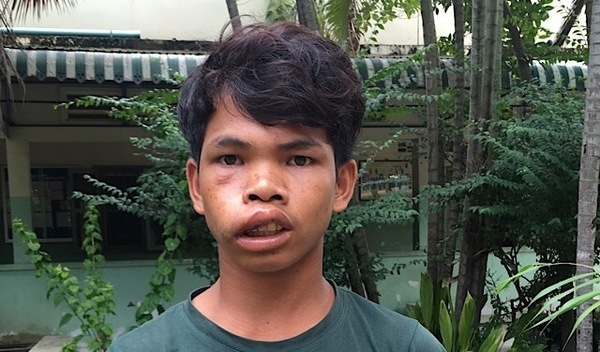 Success! Panha from Cambodia raised 220 to fund a mass removal