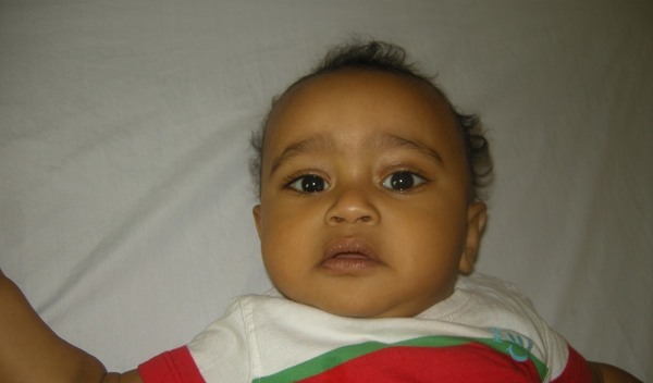 Photo of Elias post-operation