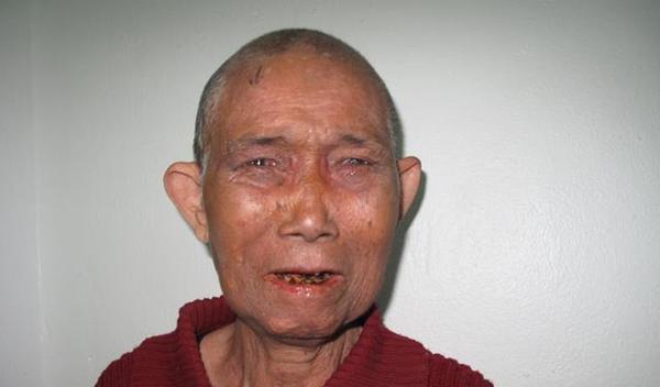 Photo of Keang post-operation