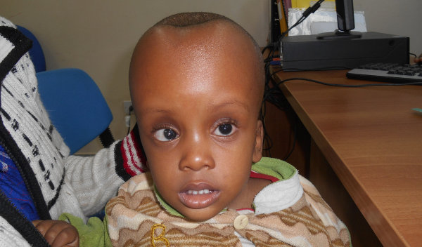 Photo of Mathayo post-operation