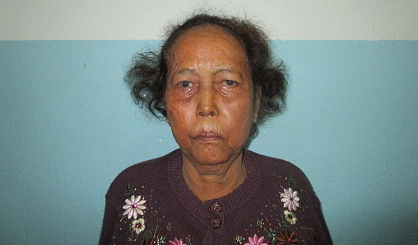 Photo of Seng post-operation