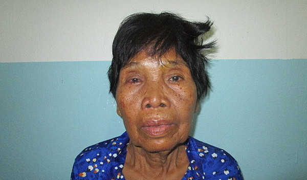 Photo of Yoeng post-operation