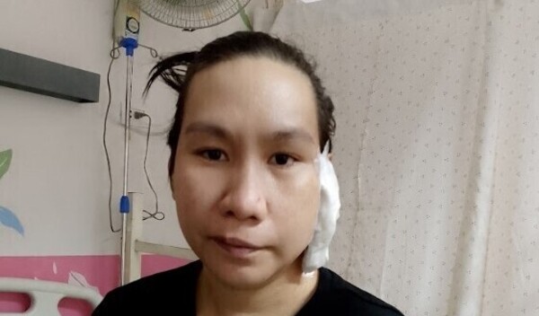 Photo of Michelle post-operation
