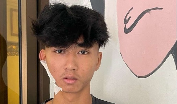 Photo of Songsak post-operation