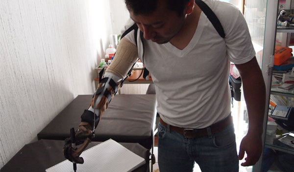 Photo of Eliazar post-operation