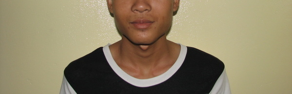 Photo of Pao post-operation