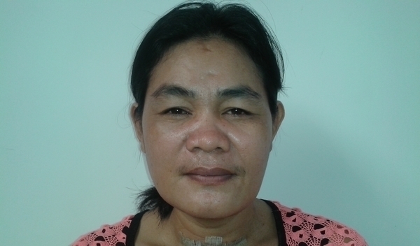 Photo of Marivic post-operation